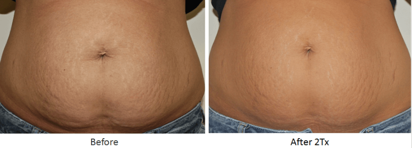 RF Body Contouring Before and After Photo Gallery, Tifton, GA